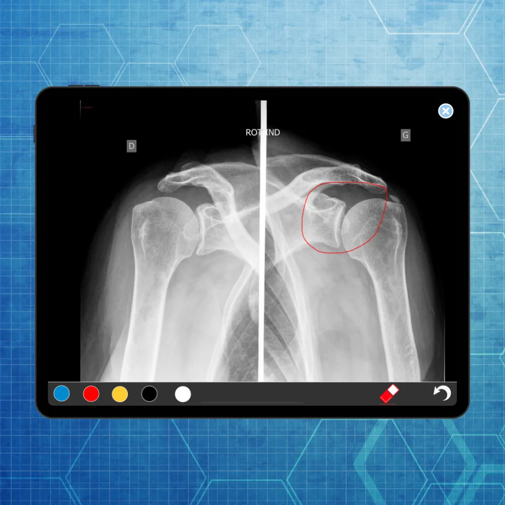 eLearning Polyarthrite rhumatoïde